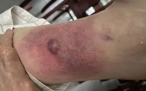 Vết thương nhỏ khi tắm biển - cảnh giác nhiễm trùng hoại tử chết người