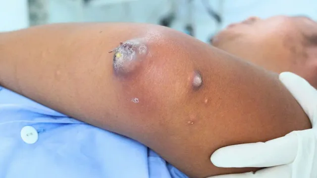 Gout gây hoại tử khuỷu tay ở tuổi 31: Bệnh đang trẻ hóa nguy hiểm