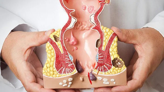 Nguyên nhân và cách phòng ngừa bệnh trĩ