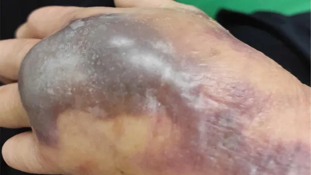 Chủ quan với vết thương hở, cụ ông 74 tuổi sốc nhiễm khuẩn do tụ cầu vàng