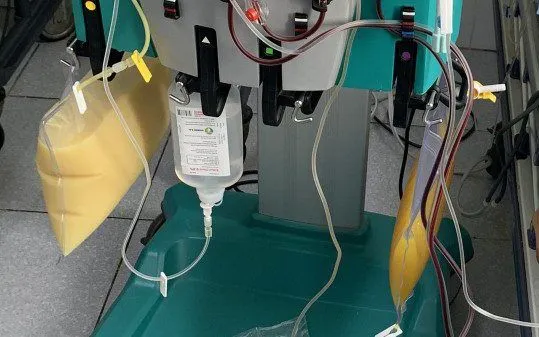 Cứu sống người bệnh viêm tụy cấp hoại tử do rối loạn mỡ máu và lạm dụng rượu