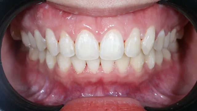 Niềng răng có phải chỉ giải quyết vấn đề thẩm mỹ?