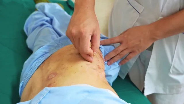 Zona thần kinh: Từ tổn thương da đến biến chứng nguy hiểm