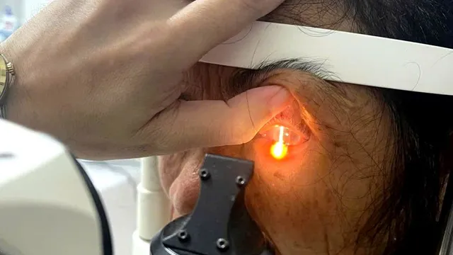 Người phụ nữ suýt hỏng mắt vì dùng hạt na ngâm rượu gội đầu trị chấy