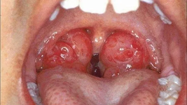 Cẩn trọng khi trẻ bị viêm amidan, VA tái phát nhiều lần