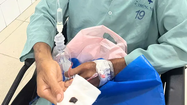 Ho kéo dài suốt 1 năm, phát hiện mảnh vỏ ốc mắc trong phế quản