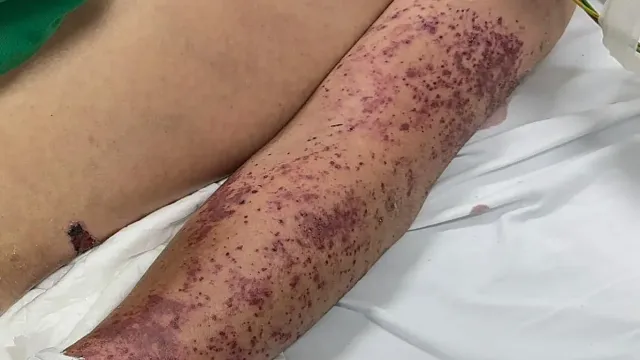 Mắc liên cầu lợn sau nhiều lần ăn lòng lợn, nem chua