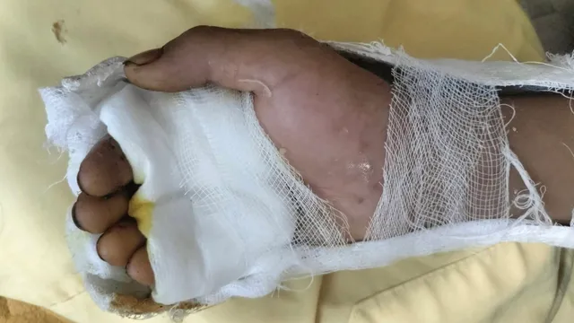 Phẫu thuật nối gân, phục hồi bàn tay cho bé trai bị dao cứa đứt 4 ngón
