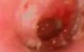 Nguy cơ thủng màng nhĩ ở trẻ từ thói quen hằng ngày