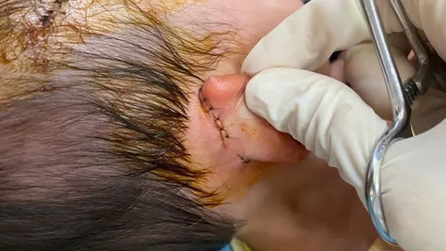 Bé 19 tháng tuổi bị chó dữ cắn vào vùng nguy hiểm