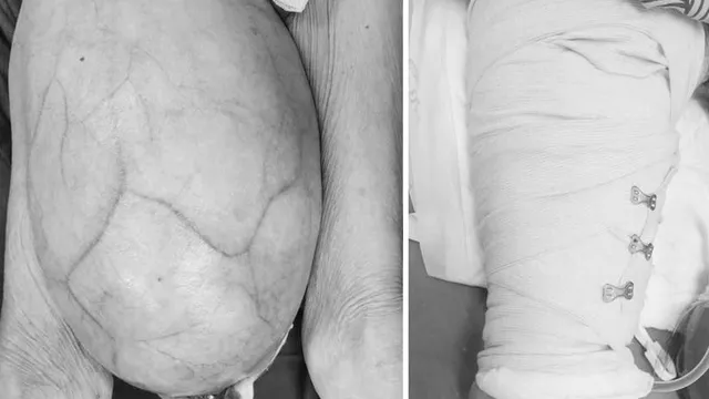 4 giờ phẫu thuật cắt bỏ khối u 8,2kg cho cụ ông 93 tuổi