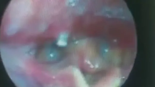 Cảnh báo nguy hiểm từ hóc xương cá: Không nên chữa mẹo