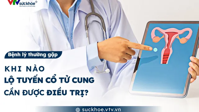Khi nào lộ tuyến cổ tử cung cần được điều trị?