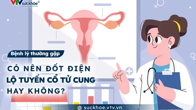 Có nên đốt điện lộ tuyến cổ tử cung hay không?