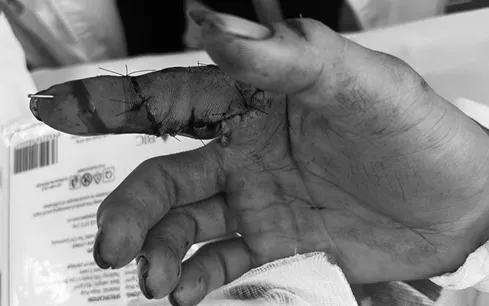 Hồi sinh ngón tay đứt lìa nhờ kỹ thuật vi phẫu hiện đại