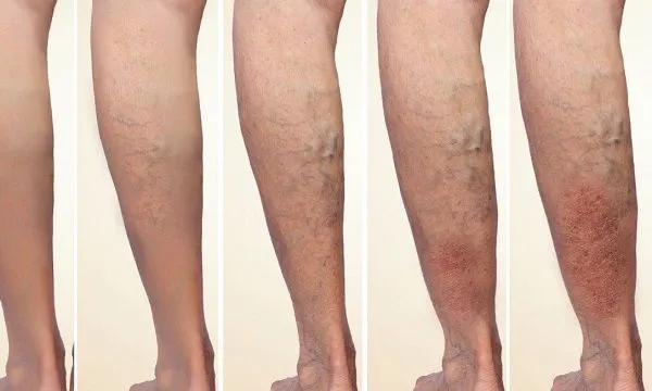 Suy tĩnh mạch chi dưới: Hiểu đúng để phòng ngừa và điều trị hiệu quả