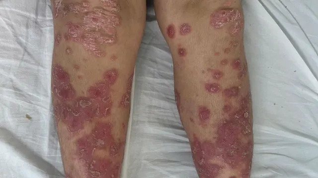 Vảy nến - Căn bệnh da liễu không đơn giản chỉ là bong tróc da