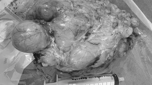 Bóc thành công khối u mỡ “khủng” cho bệnh nhân mang u phổi nguy hiểm