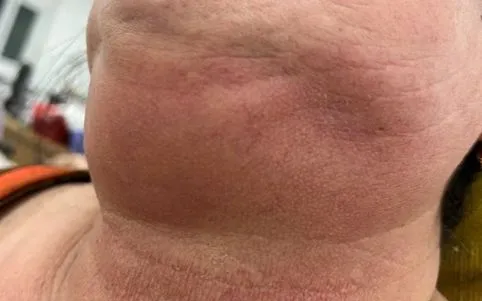 Cảnh báo nhiễm trùng răng miệng ở người bệnh đái tháo đường