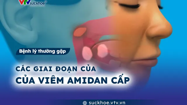 Các giai đoạn của viêm amidan cấp
