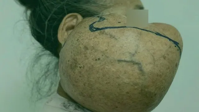 Gỡ bỏ khối u khổng lồ hơn 40 năm trên mặt người phụ nữ dân tộc Thái