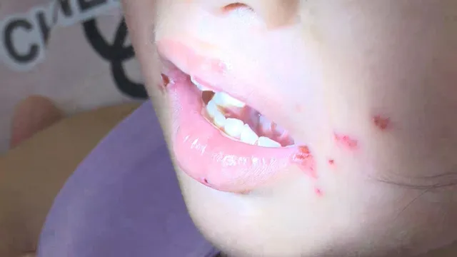 TP Hồ Chí Minh ghi nhận hơn 3.200 ca sốt xuất huyết và tay chân miệng trong tuần 44