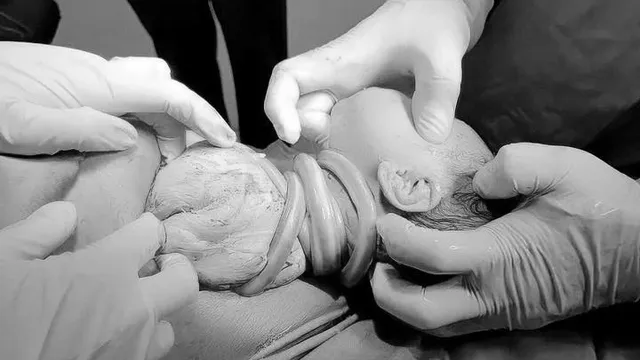 Bé gái chào đời an toàn dù có 6 vòng dây rốn quấn cổ, mẹ bị tiền sản giật