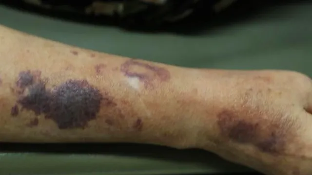 Cảnh báo nguy hiểm từ việc tự ý dùng thuốc corticoid