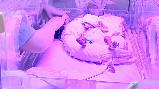 Kỳ tích sau 50 ngày hồi sinh của bé sinh non 30 tuần