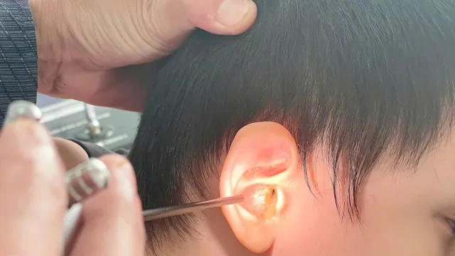 Gia tăng ca viêm tai giữa mủ ở trẻ em