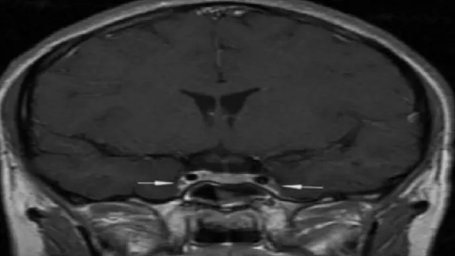 Cảnh báo viêm tắc tĩnh mạch xoang hang: Căn bệnh hiếm nhưng tử vong cao