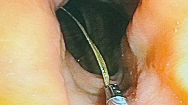 Cảnh báo nguy cơ thủng tạng rỗng do dị vật tiêu hóa