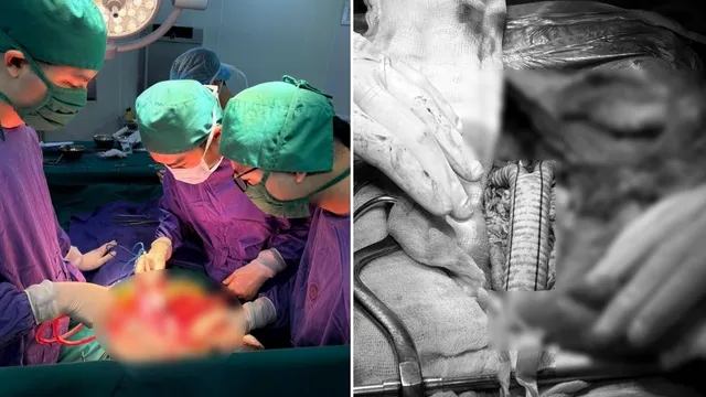 Phẫu thuật thay khối phình động mạch chủ bụng, xử trí sỏi mật trong một ca mổ