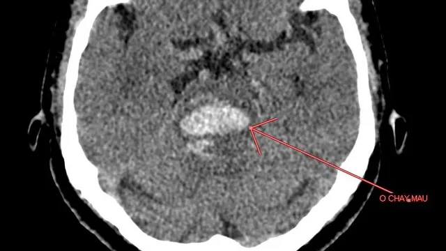 Chảy máu não do tăng huyết áp