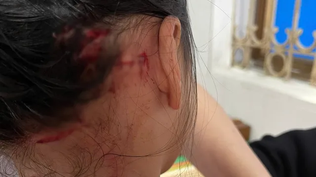 Cảnh báo nguy hiểm khi trẻ bị chó cắn