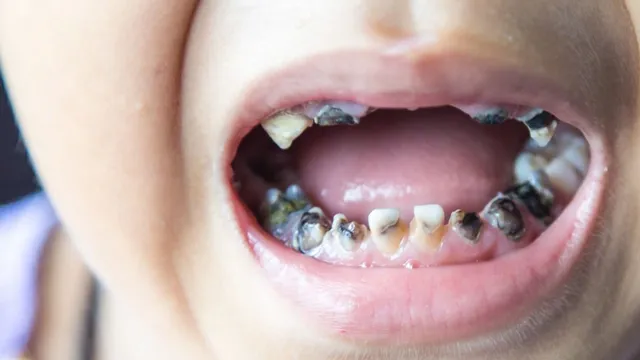 Trẻ nhập viện vì viêm tấy lan tỏa vùng mặt do răng