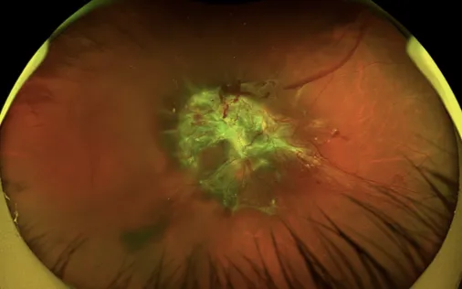 Đừng để tiểu đường cướp đi ánh sáng