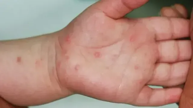 Số ca mắc tay chân miệng tăng nhanh ở Đồng bằng sông Cửu Long