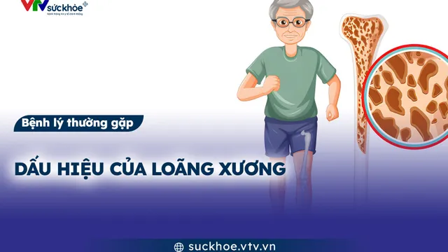 Dấu hiệu của loãng xương