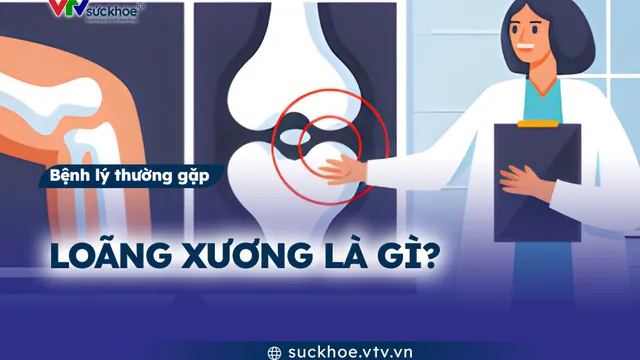Loãng xương là gì?