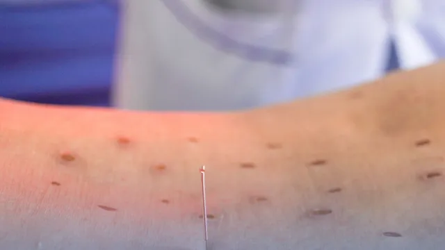 "Cứu" trị đau lưng tại nhà: Cẩn trọng tránh bỏng nhiệt