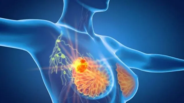 Không tự ý dán cao lên vùng sờ thấy khối u ở vú