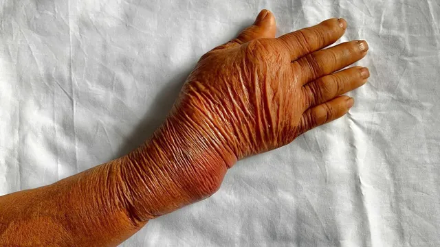 Cảnh báo nguy hiểm từ bó thuốc nam "chữa gãy xương"