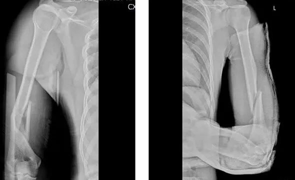 Cảnh báo nguy cơ gãy xương cánh tay từ trò chơi vật tay