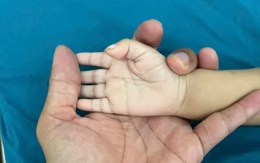 Bé 13 tháng tuổi nguy kịch vì thiếu máu nặng do thiếu sắt