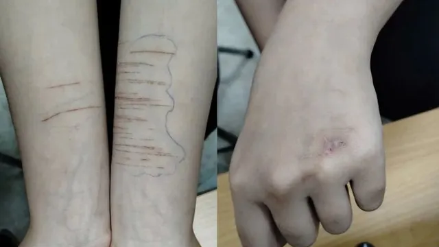 Tự gây thương tích ở trẻ vị thành niên: Xu hướng gia tăng đáng báo động