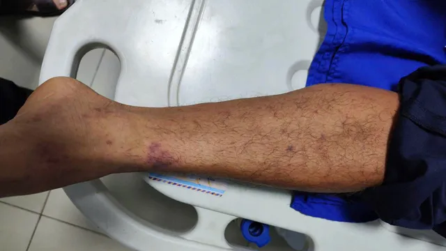 Tăng giám sát, chủ động phòng bệnh do não mô cầu