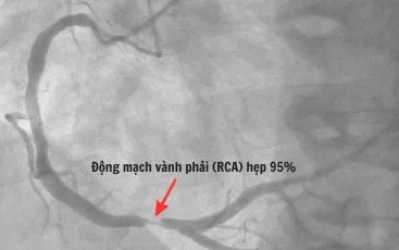Cứu sống du khách nước ngoài bị sốc tim khi đang đi du lịch ở Quảng Ninh