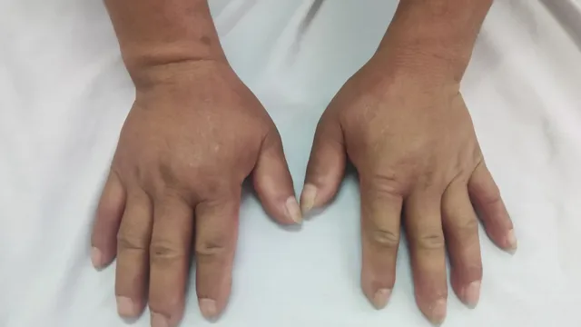 Phù tay chân kéo dài hé lộ ca xơ cứng bì hệ thống