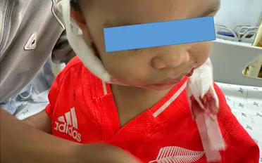 Cấp cứu bé 2 tuổi bị chó nhà cắn vào mặt